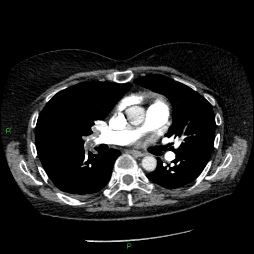 Bilateral pulmonary emboli (Radiopaedia 32700-33669 Axial C+ CTPA 52).jpg
