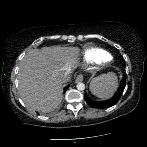 File:Bilateral pulmonary emboli (Radiopaedia 32700-33669 Axial C+ CTPA 93).jpg