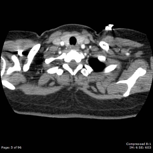 Bilateral pulmonary emboli with Hampton hump sign (Radiopaedia 54070-60246 Axial C+ CTPA 2).jpg