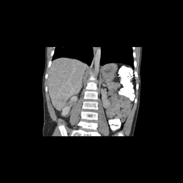 File:Bilateral renal malrotation (Radiopaedia 30901-31606 B 1).jpg