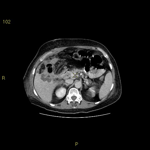 File:Biloma with drainage into the colon (Radiopaedia 20032-20068 A 5).jpg