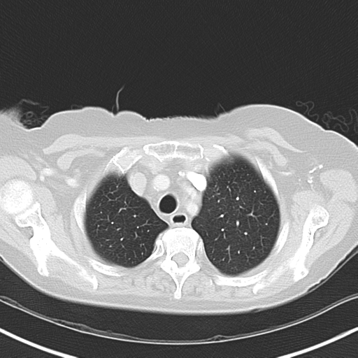 File:Bladder and bowel cancers (Radiopaedia 37688-39592 Axial lung window 10).png