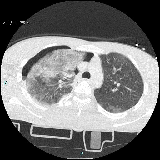 Blunt chest trauma (Swiss cheese sign) (Radiopaedia 38519-40618 Axial lung window 20).jpg