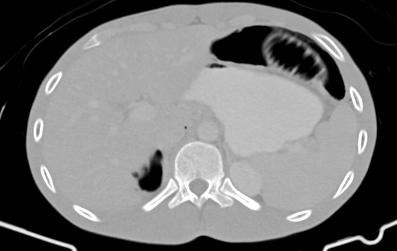 Blunt injury to the small bowel (Radiopaedia 74953-85987 Axial Wide 14).jpg