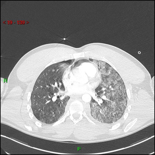 Blunt thoracic trauma (Radiopaedia 73454-84221 Axial lung window 50).jpg