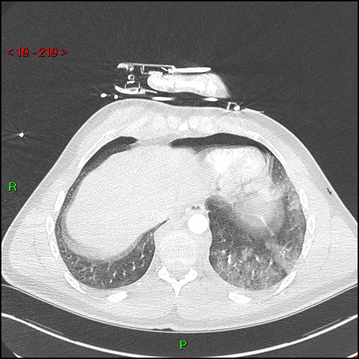 Blunt thoracic trauma (Radiopaedia 73454-84221 Axial lung window 81).jpg