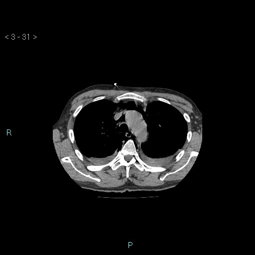 Boerhaave syndrome (Radiopaedia 27683-27897 Axial non-contrast 31).jpg