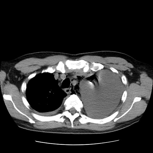 Boerhaave syndrome (Radiopaedia 59796-67310 Axial liver window 18).jpg