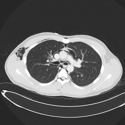 File:Boerhaave syndrome with mediastinal, axillary, neck and epidural free gas (Radiopaedia 41297-44115 Axial lung window 45).jpg