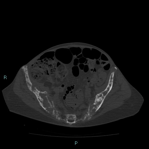 File:Bone metastases from untreated breast cancer (Radiopaedia 42973-46219 Axial bone window 159).jpg