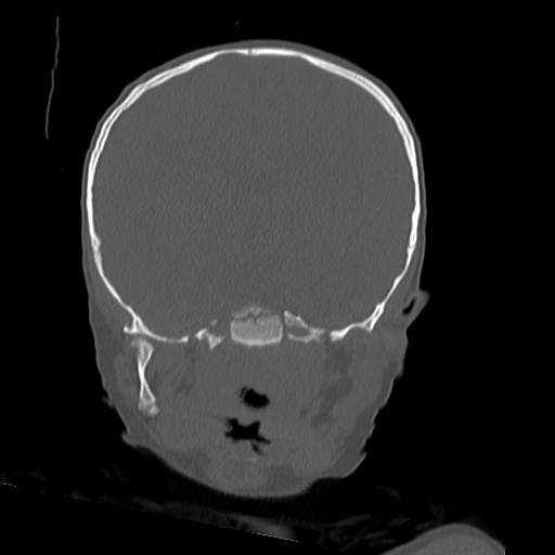 File:Bony atresia of the right external auditory canal (Radiopaedia 27916-28156 Coronal bone window 17).jpg
