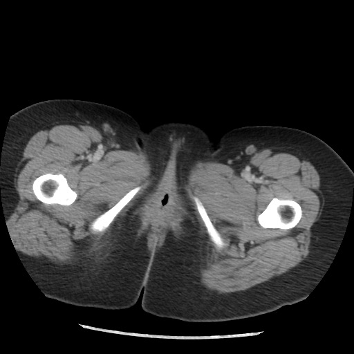 Borderline mucinous tumor (ovary) (Radiopaedia 78228-90808 A 146).jpg
