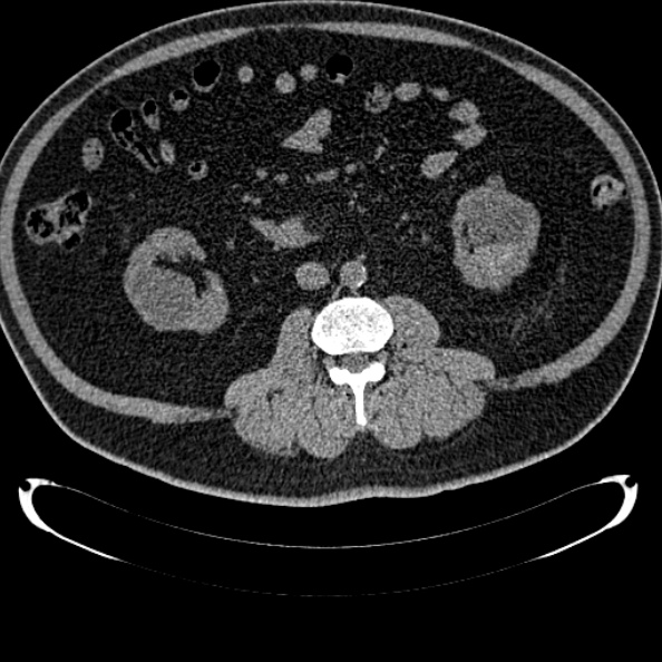 File:Bosniak renal cyst - type IV (Radiopaedia 24244-24518 Axial non-contrast 162).jpg