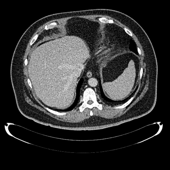 Bosniak renal cyst - type IV (Radiopaedia 24244-24518 C 32).jpg
