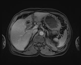 Bouveret syndrome (Radiopaedia 61017-68856 Axial T1 C+ fat sat 26).jpg