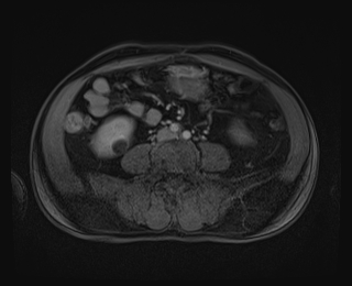 File:Bouveret syndrome (Radiopaedia 61017-68856 Axial T1 C+ fat sat 62).jpg