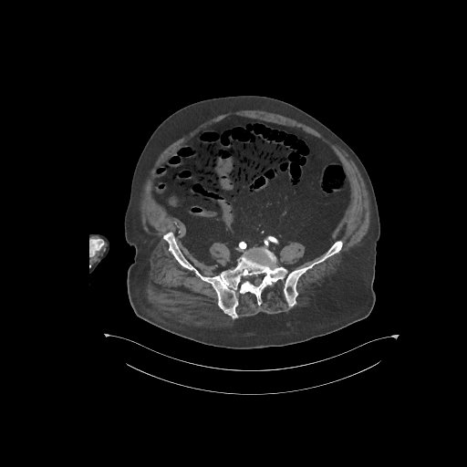 File:Bowel ischemia secondary to SMA occlusion with extensive portomesenteric venous gas (Radiopaedia 54656-60871 A 16).jpg