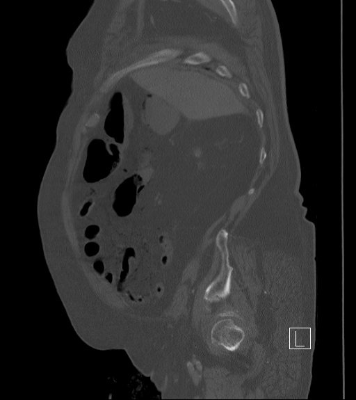 Bowel ischemia secondary to SMA occlusion with extensive portomesenteric venous gas (Radiopaedia 54656-60871 Sagittal bone window 92).jpg