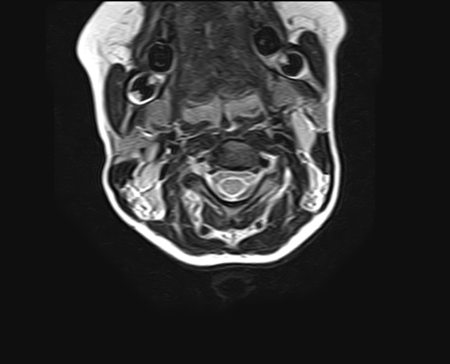 File:Brachial plexus birth palsy (Radiopaedia 68118-77604 Axial T2 3).jpg