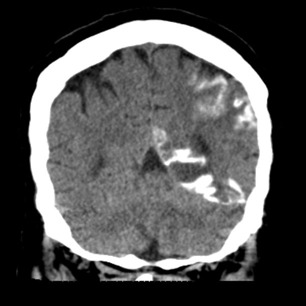 Brain cortical laminar necrosis (Radiopaedia 25822-25971 C 41).jpg