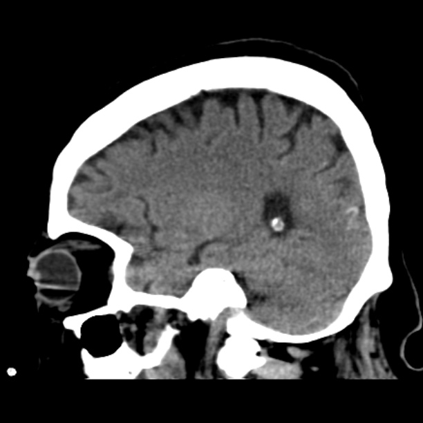 Brain cortical laminar necrosis (Radiopaedia 25822-25971 non-contrast 17).jpg