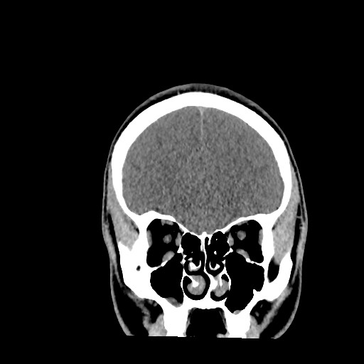 Brain death (Radiopaedia 78597-91360 Coronal non-contrast 20).jpg