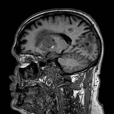 Brain metastases from lung cancer (Radiopaedia 83839-99028 Sagittal T1 49).jpg