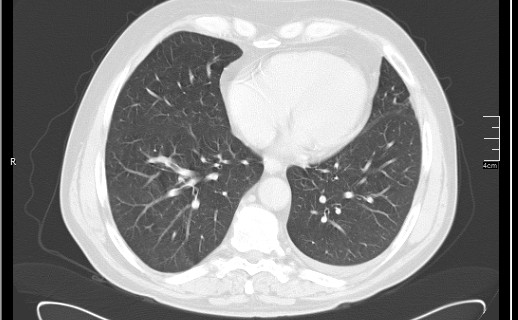 Brain metastases from squamocellular lung cancer (Radiopaedia 56515-63219 Axial lung window 45).jpg