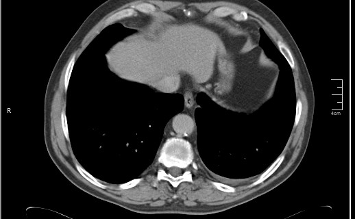 File:Brain metastases from squamocellular lung cancer (Radiopaedia 56515-63219 B 51).jpg