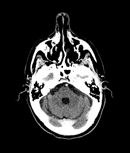 Brain metastasis (large cystic mass) (Radiopaedia 47497-52106 Axial C+ 20).png