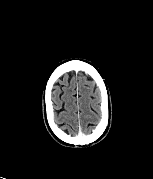 Brain metastasis (large cystic mass) (Radiopaedia 47497-52106 Axial C+ 50).png