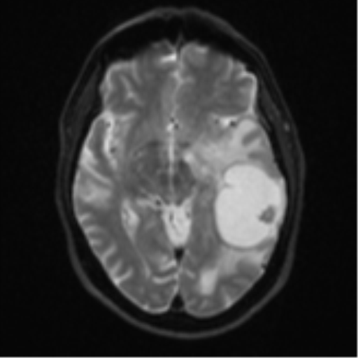 Brain metastasis (large cystic mass) (Radiopaedia 47497-52107 Axial DWI 12).png