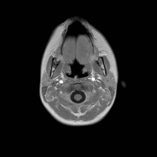 File:Brainstem ganglioglioma (Radiopaedia 10763-11224 Axial T1 C+ 18).jpg