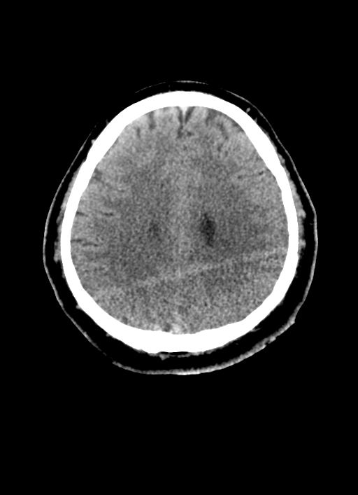 Brainstem hemorrhage (Radiopaedia 81294-94976 Axial non-contrast 22).jpg