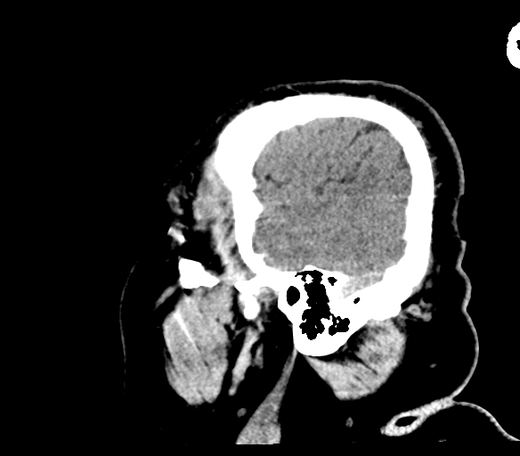File:Brainstem hemorrhage (Radiopaedia 81294-94976 C 52).jpg