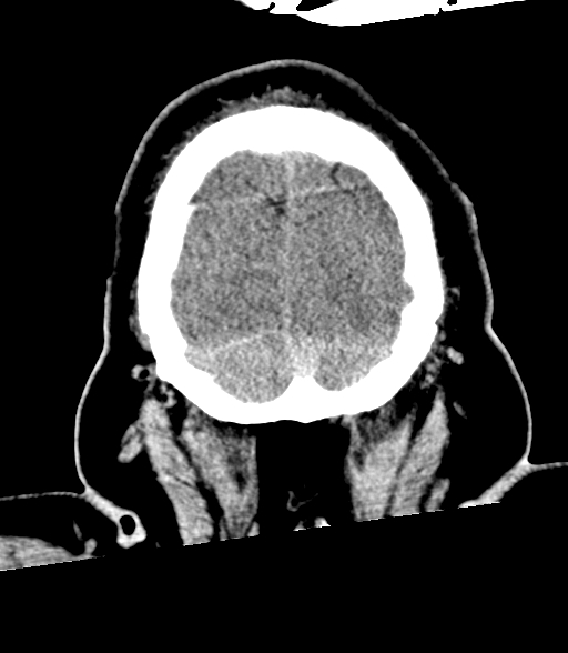 Brainstem hemorrhage (Radiopaedia 81294-94976 Coronal non-contrast 61).jpg
