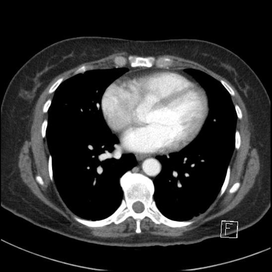 File:Breast metastases from renal cell cancer (Radiopaedia 79220-92225 A 58).jpg