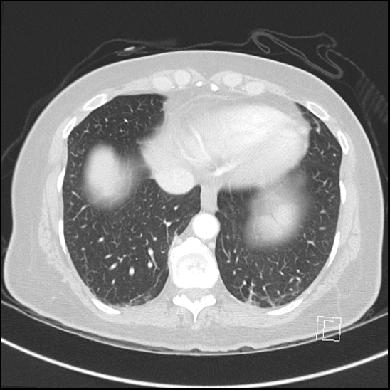 Breast metastases from renal cell cancer (Radiopaedia 79220-92225 Axial lung window 67).jpg