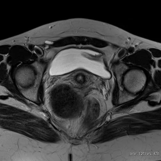 File:Broad ligament fibroid (Radiopaedia 49135-54241 Axial T2 21).jpg