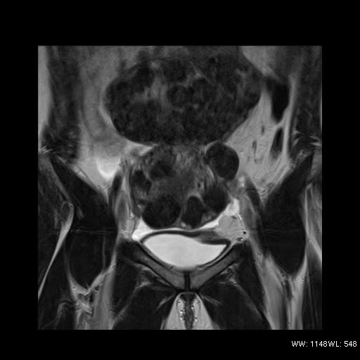 File:Broad ligament fibroid (Radiopaedia 49135-54241 Coronal T2 8).jpg