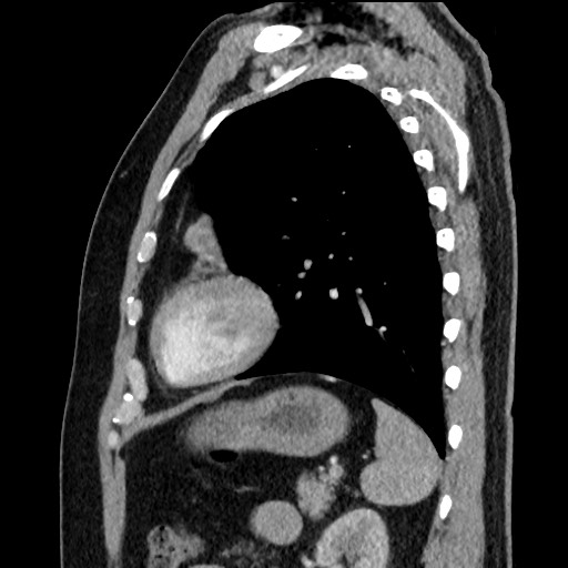 Bronchial carcinoid tumor (Radiopaedia 67377-76764 E 51).jpg