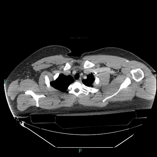 Bronchial carcinoid tumor (Radiopaedia 78272-90870 C 23).jpg