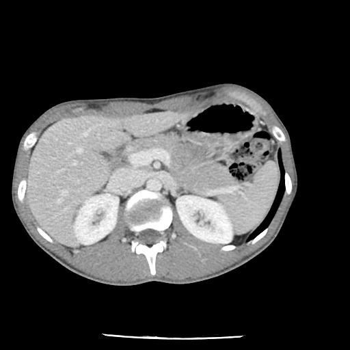 File:Bronchial carcinoid tumor causing right lower lobe collapse (Radiopaedia 83495-98594 A 58).jpg