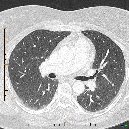 Bronchial diverticula (Radiopaedia 79512-92676 Axial lung window 85).jpg