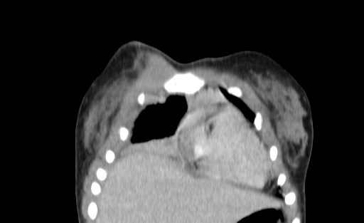 Bronchial mucoepidermoid carcinoma (Radiopaedia 57023-63895 Coronal 8).jpg