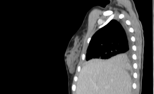 Bronchial mucoepidermoid carcinoma (Radiopaedia 57023-63895 Sagittal 26).jpg