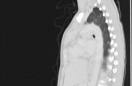 Bronchial mucoepidermoid carcinoma (Radiopaedia 57023-63895 Sagittal lung window 105).jpg