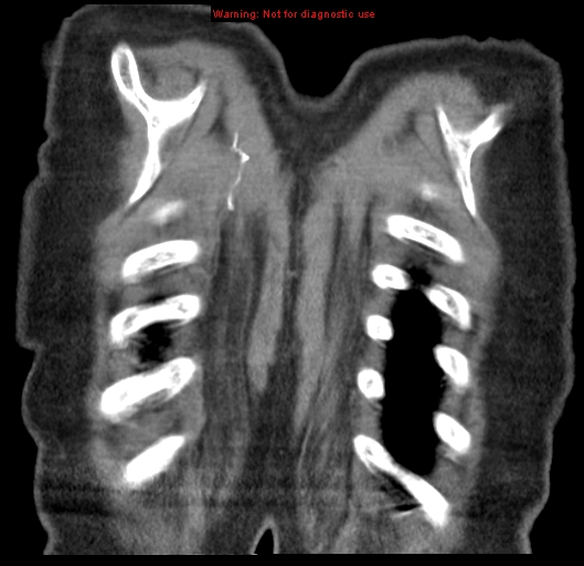 Bronchoalveolar carcinoma (BAC) (Radiopaedia 13436-13392 E 57).jpg