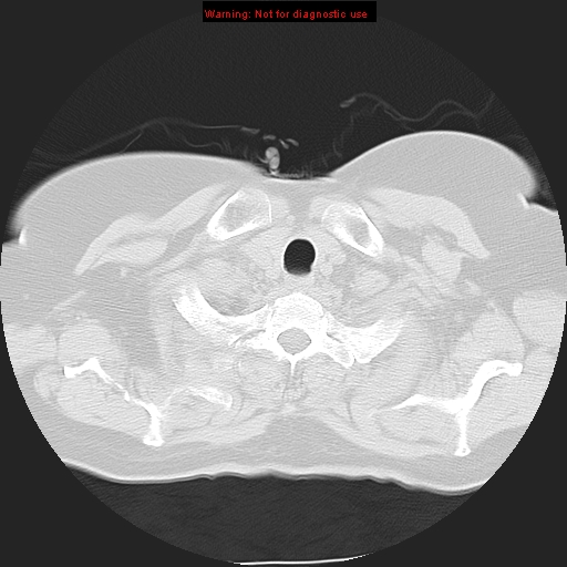 Bronchoalveolar carcinoma (Radiopaedia 13224-13233 Axial lung window 5).jpg
