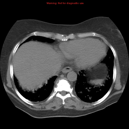 File:Bronchoalveolar carcinoma (Radiopaedia 13224-13233 Axial non-contrast 34).jpg